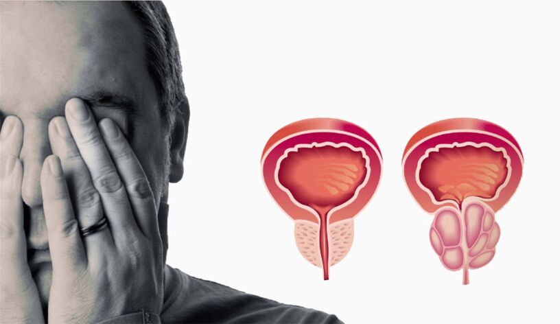 Kronični prostatitis