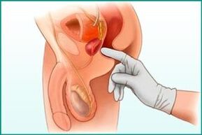 Palpacija prostate