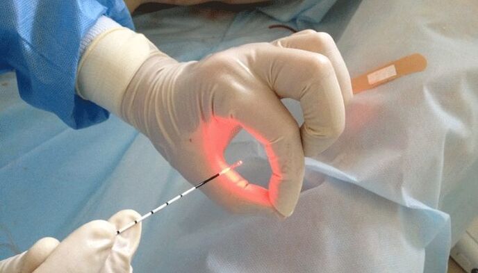lasersko liječenje prostatitisa